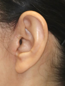 新宿ラクル美容外科クリニック　山本厚志　ナチュラルフェイスリフト　耳の傷痕　手術後１２ヶ月目　３月３１日