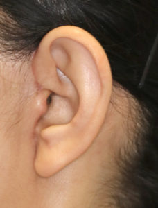 新宿ラクル美容外科クリニック　山本厚志　ナチュラルフェイスリフト　耳の傷痕　手術後１ヶ月目　３月３１日