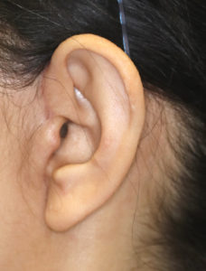 新宿ラクル美容外科クリニック　山本厚志　ナチュラルフェイスリフト　耳の傷痕　手術後２ヶ月目　３月３１日