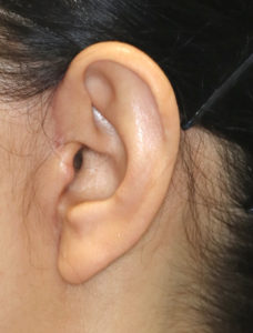 新宿ラクル美容外科クリニック　山本厚志　ナチュラルフェイスリフト　耳の傷痕　手術後３ヶ月目　３月３１日
