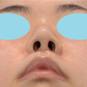 「耳介軟骨移植＋鼻尖縮小（close法）」　新宿ラクル美容外科クリニック　３０代女性　手術前　５月２日