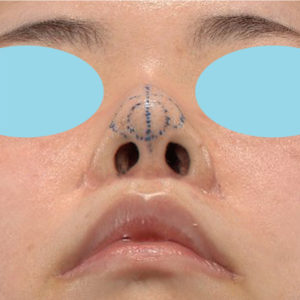 「耳介軟骨移植＋鼻尖縮小（close法）」　新宿ラクル美容外科クリニック　３０代女性　デザイン　５月２日