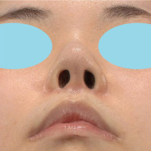 「耳介軟骨移植＋鼻尖縮小（close法）」　新宿ラクル美容外科クリニック　３０代女性　手術後３ヶ月目　９月２１日