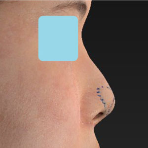 「耳介軟骨移植＋鼻尖縮小（close法）」　新宿ラクル美容外科クリニック　３０代女性　デザイン　５月２日