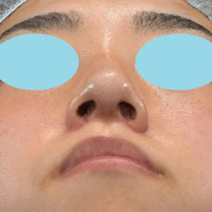 新宿ラクル美容外科クリニック　山本厚志　「小鼻縮小+α法」　手術後１ヶ月目　６月２４日