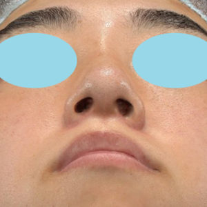 新宿ラクル美容外科クリニック　山本厚志　「小鼻縮小+α法」　手術後３ヶ月目　１１月１０日