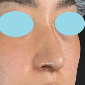 新宿ラクル美容外科クリニック　山本厚志　「小鼻縮小+α法」　手術後１ヶ月目　６月２４日