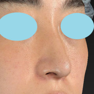 新宿ラクル美容外科クリニック　山本厚志　「小鼻縮小+α法」　手術後３ヶ月目　１１月１０日
