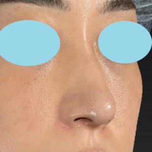 新宿ラクル美容外科クリニック　山本厚志　「小鼻縮小+α法」　手術後６ヶ月目　１１月１０日