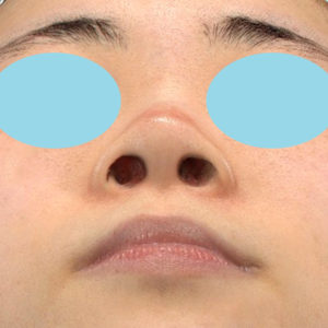 新宿ラクル美容外科クリニック　山本厚志　「小鼻縮小+α法」　手術前　７月１６日