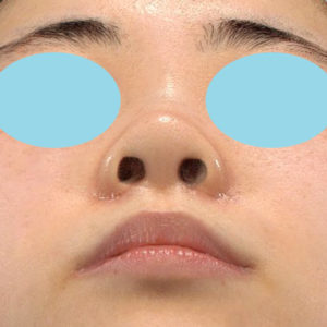 新宿ラクル美容外科クリニック　山本厚志　「小鼻縮小+α法」　手術後１ヶ月目　７月１６日