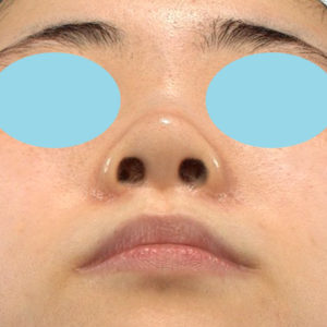 新宿ラクル美容外科クリニック　山本厚志　「小鼻縮小+α法」　手術後２ヶ月目　７月１６日