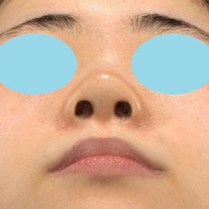 新宿ラクル美容外科クリニック　山本厚志　「小鼻縮小+α法」　手術後３ヶ月目　７月１６日