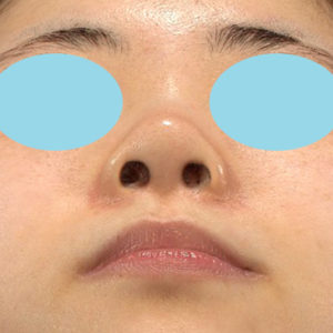 新宿ラクル美容外科クリニック　山本厚志　「小鼻縮小+α法」　手術後６ヶ月目　１０月２２日