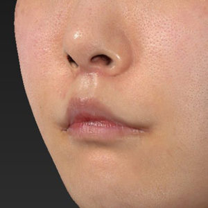 新宿ラクル美容外科クリニック　山本厚志　「口角挙上（スマイルリップ）+ 人中短縮術（リップリフト）」　手術後１ヶ月目　7月26日