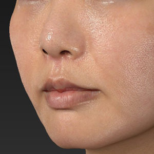 新宿ラクル美容外科クリニック　山本厚志　「貴族手術（鼻翼基部プロテーゼ）+ 人中短縮術（リップリフト）」　手術後２ヶ月目　８月４日