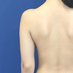 新宿ラクル美容外科クリニック　山本厚志　「ライポライフ脂肪吸引（二の腕+背中上部）」　手術前　１月２８日