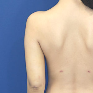 新宿ラクル美容外科クリニック　山本厚志　「ライポライフ脂肪吸引（二の腕+背中上部）」　手術後１週間目　１月２８日