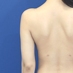 新宿ラクル美容外科クリニック　山本厚志　「ライポライフ脂肪吸引（二の腕+背中上部）」　手術後１ヶ月目　１月２８日