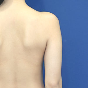 新宿ラクル美容外科クリニック　山本厚志　「ライポライフ脂肪吸引（二の腕+背中上部）」　手術前　１月２８日