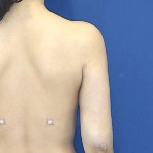 新宿ラクル美容外科クリニック　山本厚志　「ライポライフ脂肪吸引（二の腕+背中上部）」　手術直後　１月２８日