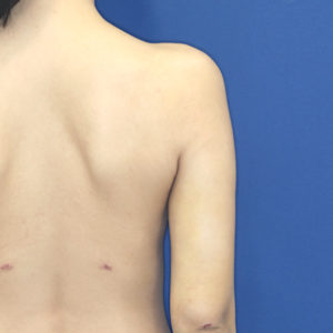 新宿ラクル美容外科クリニック　山本厚志　「ライポライフ脂肪吸引（二の腕+背中上部）」　手術後１週間目　１月２８日