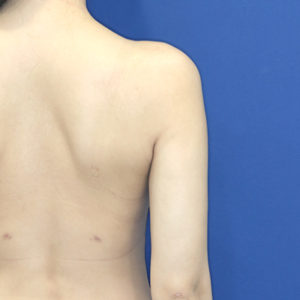 新宿ラクル美容外科クリニック　山本厚志　「ライポライフ脂肪吸引（二の腕+背中上部）」　手術後１ヶ月目　１月２８日