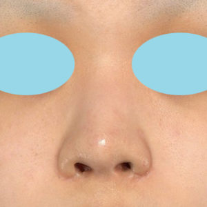 「鼻孔縁下降術」　新宿ラクル美容外科クリニック　１０代女性　手術前　８月２９日