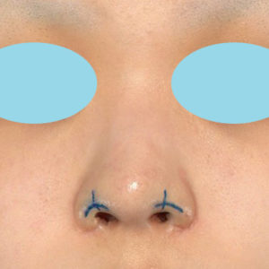 「鼻孔縁下降術」　新宿ラクル美容外科クリニック　１０代女性　デザイン　８月２９日