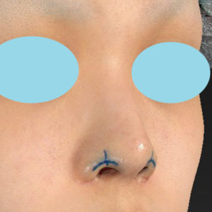 「鼻孔縁下降術」　新宿ラクル美容外科クリニック　１０代女性　デザイン　８月２９日