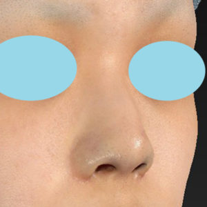 「鼻孔縁下降術」　新宿ラクル美容外科クリニック　１０代女性　手術直後　８月２９日