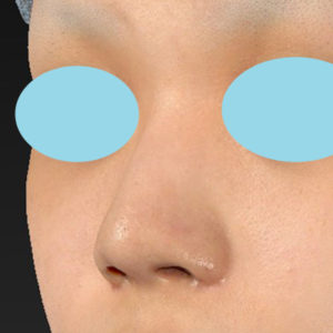 「鼻孔縁下降術」　新宿ラクル美容外科クリニック　１０代女性　手術後１週間目　８月２９日