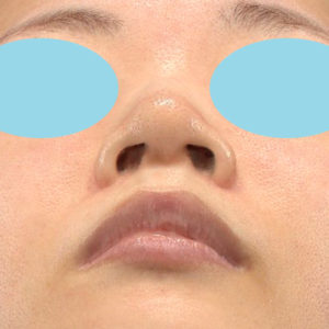 「耳介軟骨移植＋鼻尖縮小（close法）＋小鼻縮小+α」　新宿ラクル美容外科クリニック　３０代女性　手術前　９月１９日