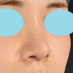 「鼻中隔延長＋鼻尖形成＋鼻プロテーゼ隆鼻術」　新宿ラクル美容外科クリニック　２０代女性　手術後２ヶ月目　１０月１０日