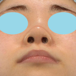 新宿ラクル美容外科クリニック　山本厚志　「小鼻縮小+α法」　手術後１２ヶ月目　５月９日