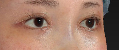 新宿ラクル美容外科クリニック　山本厚志　下眼瞼下制術（グラマラスライン形成術（皮膚切開法））+目尻切開+目頭切開　手術後１ヶ月目　１月１１日