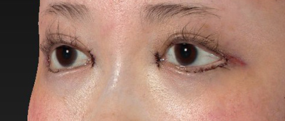新宿ラクル美容外科クリニック　山本厚志　下眼瞼下制術（グラマラスライン形成術（皮膚切開法））+目尻切開+目頭切開　手術直後　１月１１日