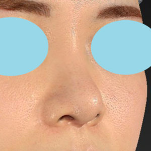 「鼻中隔延長＋鼻尖形成＋鼻プロテーゼ隆鼻術」　新宿ラクル美容外科クリニック　２０代女性　手術後３ヶ月目　３月１２日