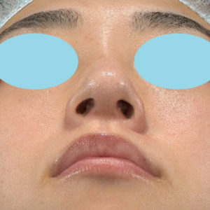 新宿ラクル美容外科クリニック　山本厚志　「小鼻縮小+α法」　手術後１２ヶ月目　３月１６日