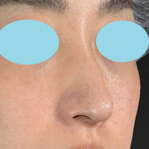 新宿ラクル美容外科クリニック　山本厚志　「小鼻縮小+α法」　手術後１２ヶ月目　３月１６日