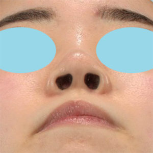 新宿ラクル美容外科クリニック　山本厚志　「鼻プロテーゼ隆鼻術＋鼻尖縮小（close法）」　手術後１２ヶ月目　１月１４日