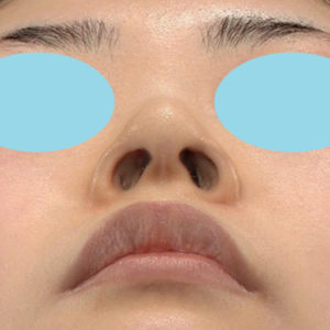 新宿ラクル美容外科クリニック　山本厚志　「小鼻縮小+α法」　手術前　２月１日
