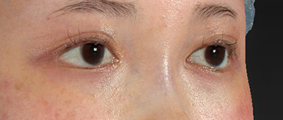新宿ラクル美容外科クリニック　山本厚志　下眼瞼下制術（グラマラスライン形成術（皮膚切開法））+目尻切開+目頭切開　手術後２ヶ月目　１月２６日