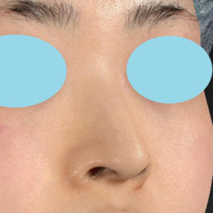 新宿ラクル美容外科クリニック　山本厚志　「小鼻縮小+α法」　手術前　２月１日
