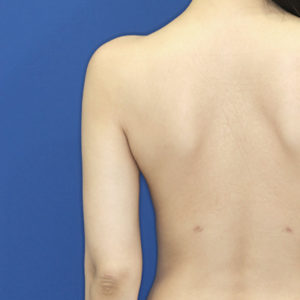 新宿ラクル美容外科クリニック　山本厚志　「ライポライフ脂肪吸引（二の腕+背中上部）」　手術後２ヶ月目　４月２６日