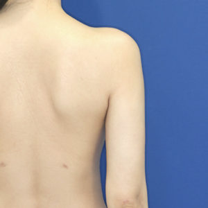新宿ラクル美容外科クリニック　山本厚志　「ライポライフ脂肪吸引（二の腕+背中上部）」　手術後２ヶ月目　４月２６日