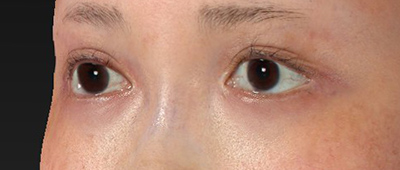 新宿ラクル美容外科クリニック　山本厚志　下眼瞼下制術（グラマラスライン形成術（皮膚切開法））+目尻切開+目頭切開　手術後６ヶ月目　６月２２日