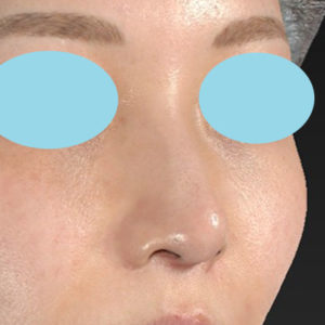 新宿ラクル美容外科クリニック　山本厚志　「小鼻縮小+α法」　手術後１２ヶ月目　５月１０日