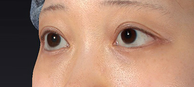 新宿ラクル美容外科クリニック　山本厚志　下眼瞼下制術（グラマラスライン形成術（皮膚切開法））+目尻切開　手術後３ヶ月目　６月１８日