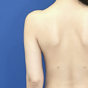 新宿ラクル美容外科クリニック　山本厚志　「ライポライフ脂肪吸引（二の腕+背中上部）」　手術後３ヶ月目　１月３１日